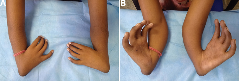 (A) Dorsal aspect and (B) palmar aspect of both hands showing the absence of thumbs bilaterally in a case of congenital bilateral radial longitudinal deficiency.
